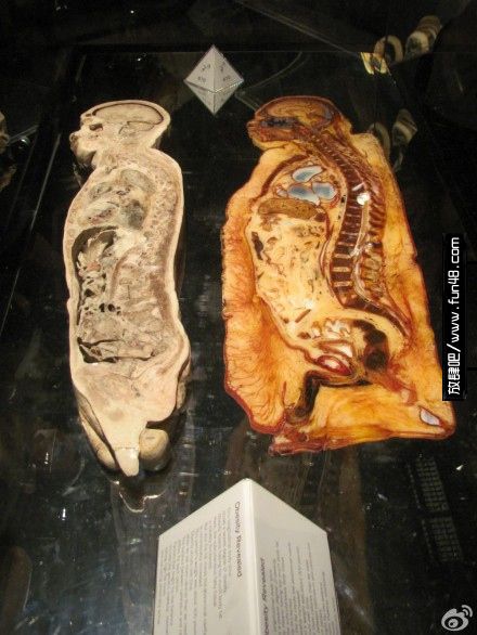 胖子和瘦子尸体解剖对比